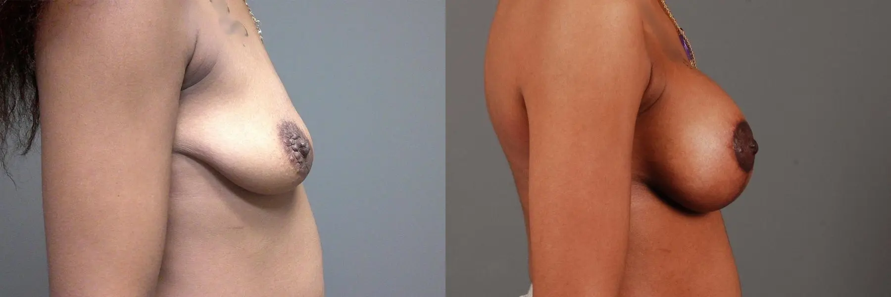 Breast Lift With Implants: Patient 1 - Before and After 4