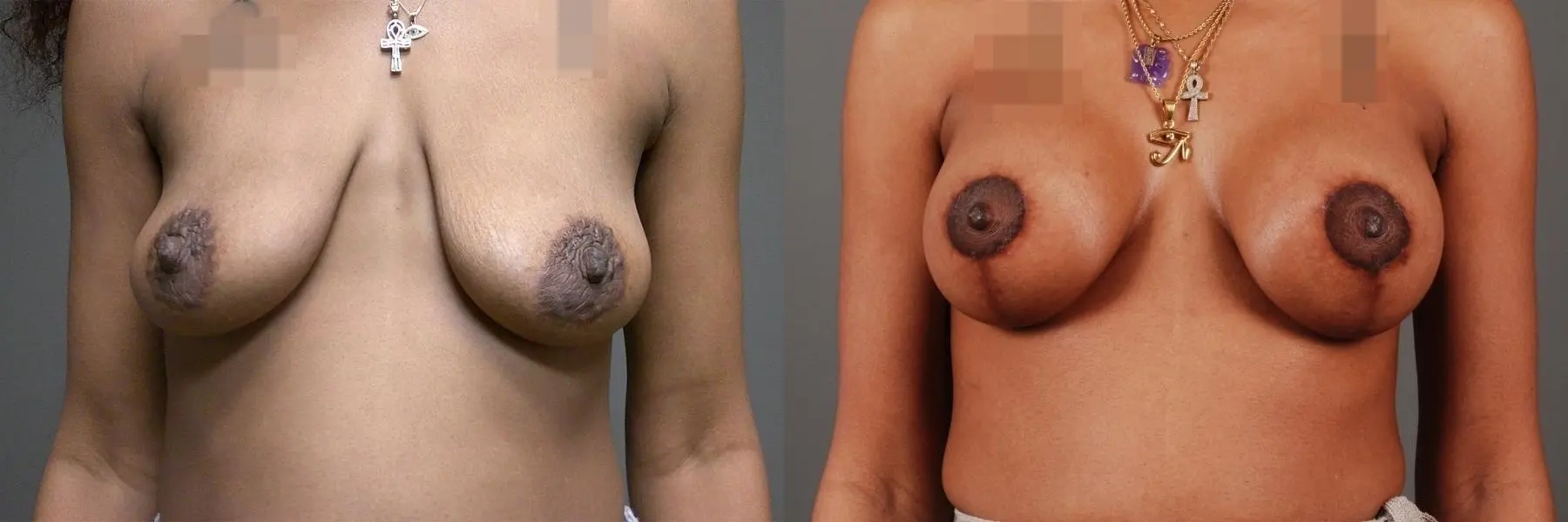 Breast Lift With Implants: Patient 1 - Before and After 3