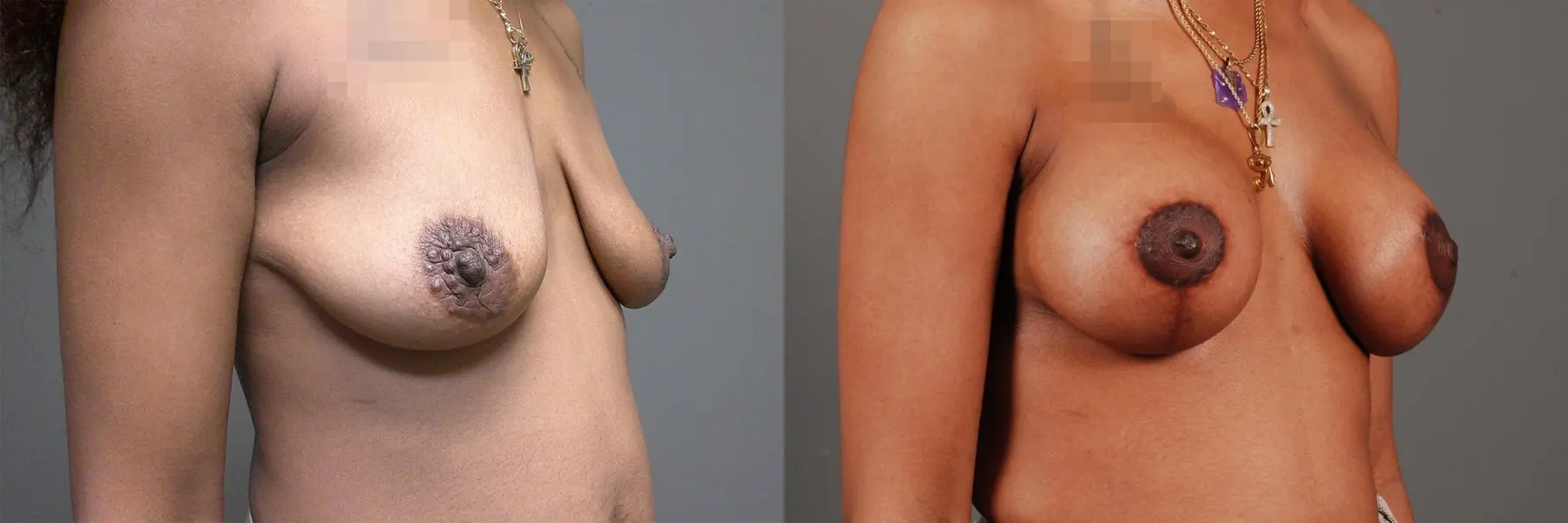 Breast Lift With Implants: Patient 1 - Before and After 1