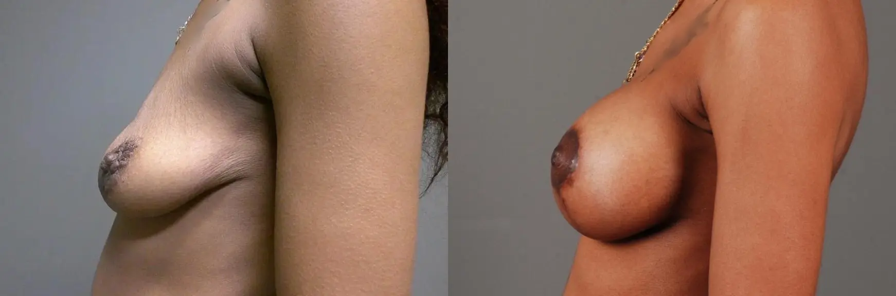 Breast Lift With Implants: Patient 1 - Before and After 5