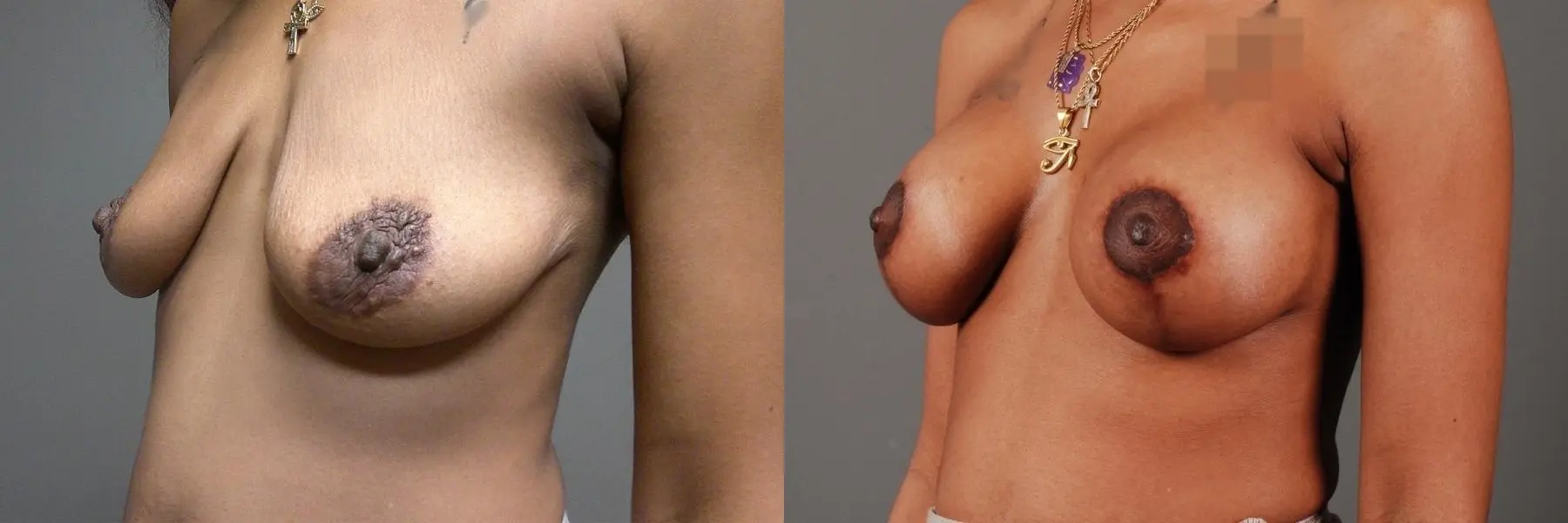 Breast Lift With Implants: Patient 1 - Before and After 2