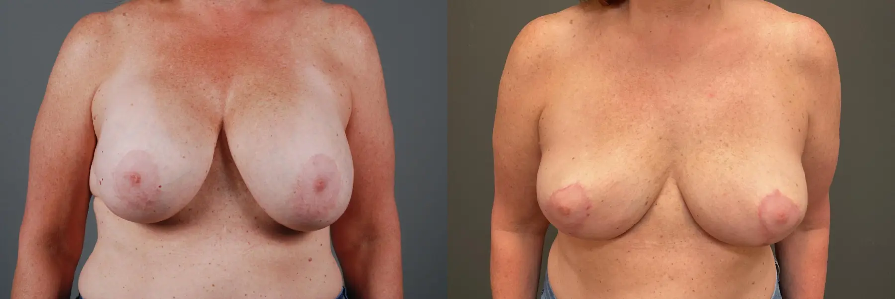 Capsulectomy : Patient 1 - Before and After 1