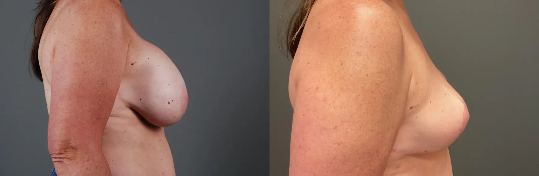 Capsulectomy : Patient 1 - Before and After 5