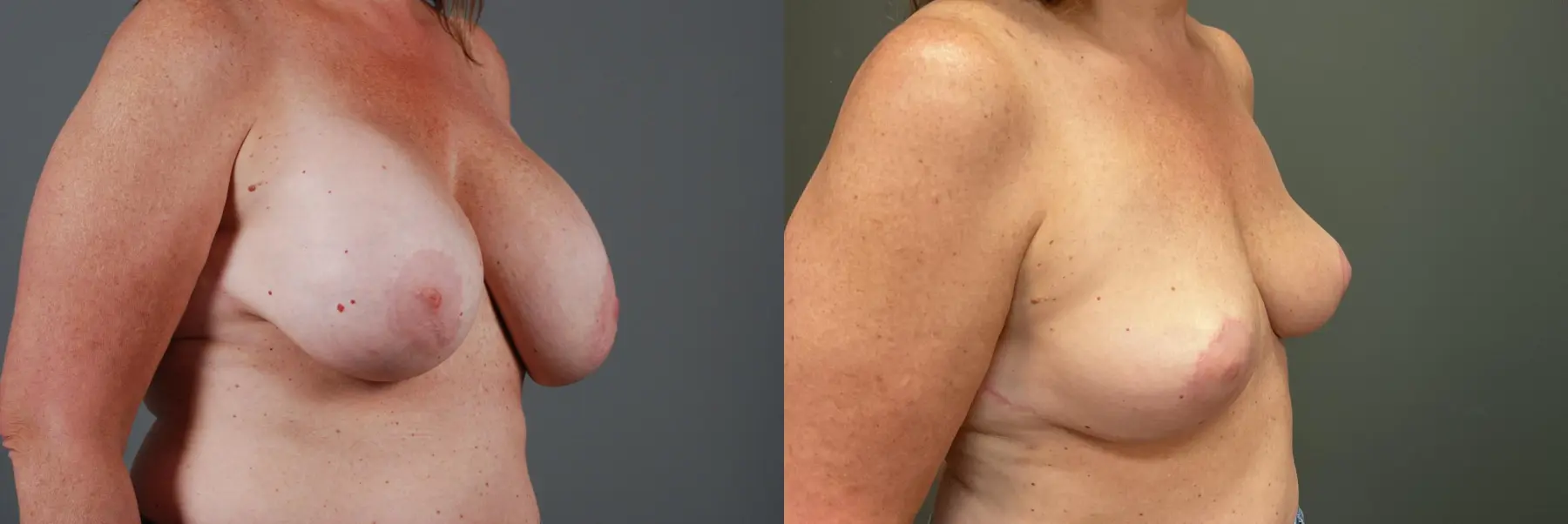 Capsulectomy : Patient 1 - Before and After 3