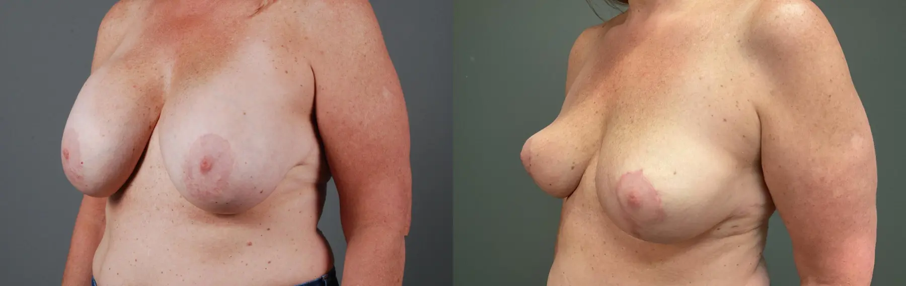 Capsulectomy : Patient 1 - Before and After 4