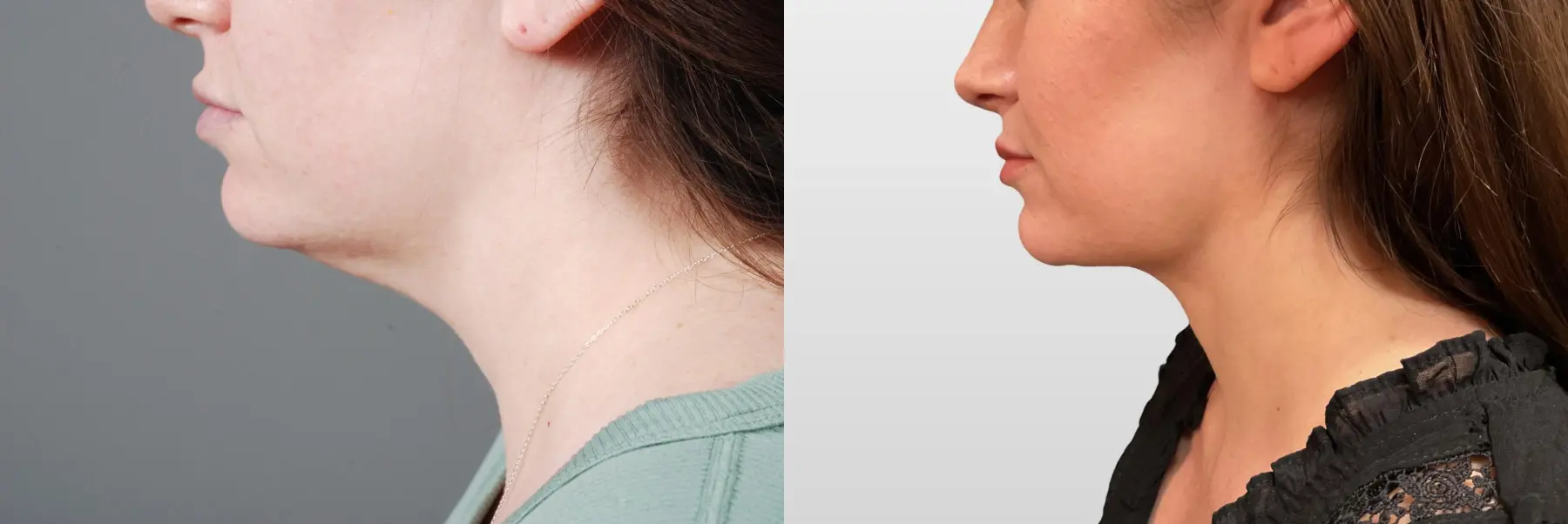Facelift & Neck Lift: Patient 3 - Before and After 3