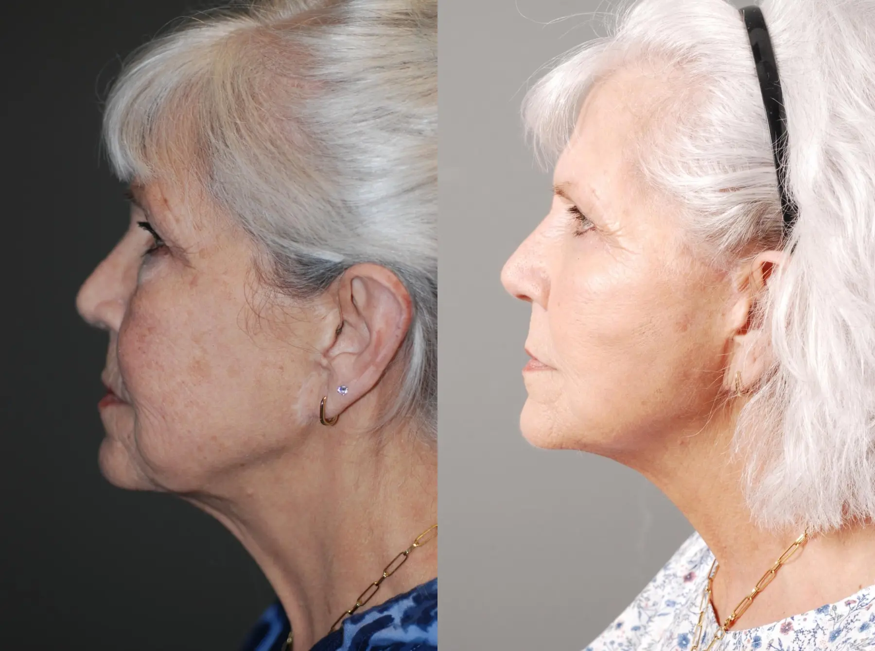 Facelift & Neck Lift: Patient 1 - Before and After 5