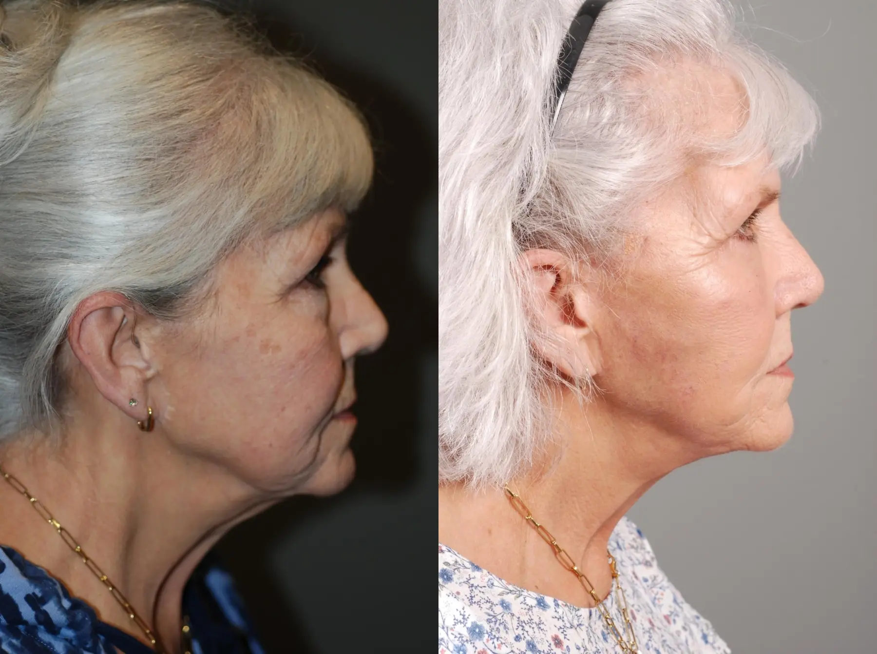 Facelift & Neck Lift: Patient 1 - Before and After 4