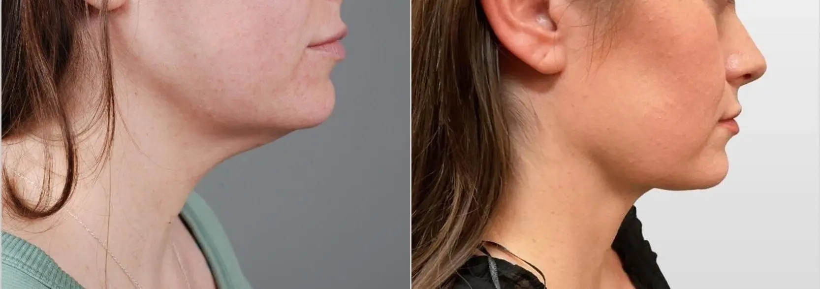 Facelift & Neck Lift: Patient 3 - Before and After 2