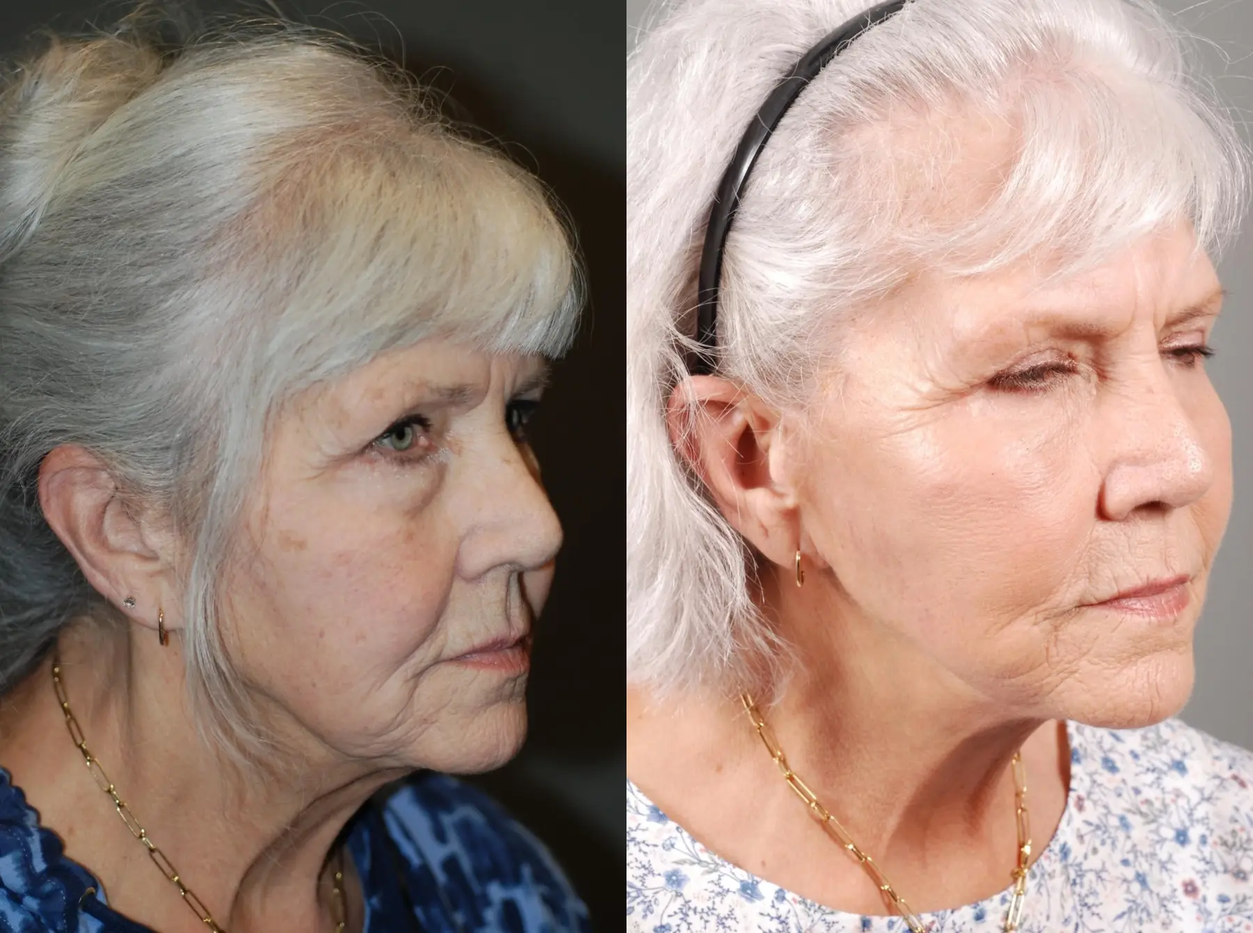 Facelift & Neck Lift: Patient 1 - Before and After 2
