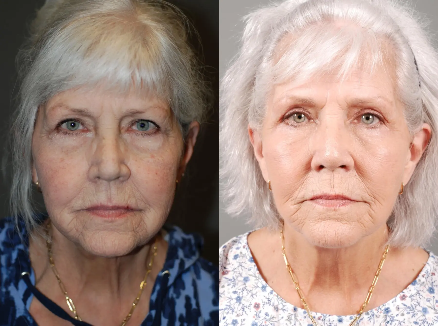 Facelift & Neck Lift: Patient 1 - Before and After 1