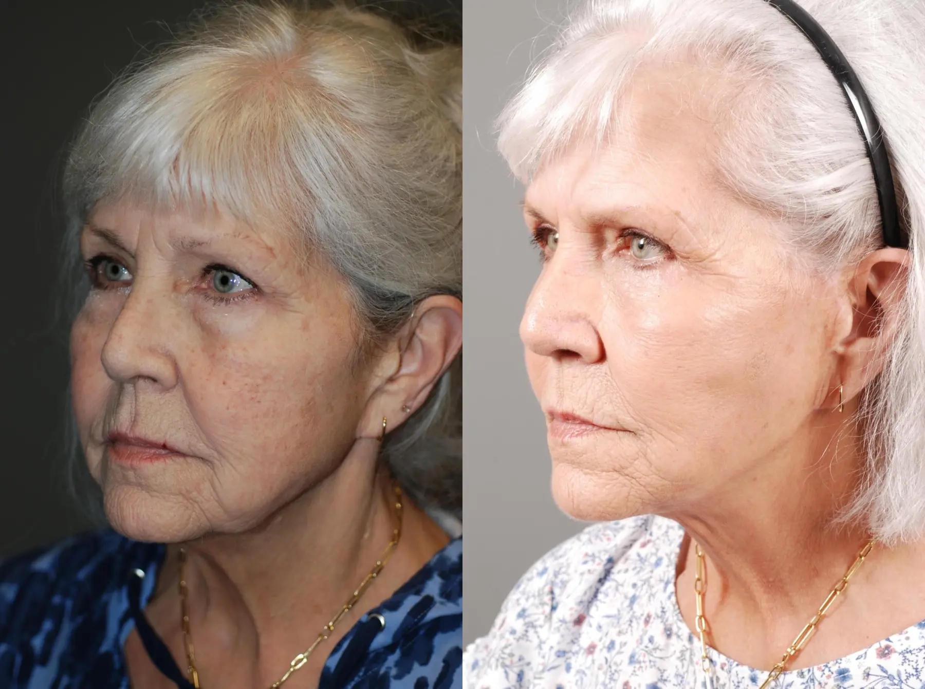 Facelift & Neck Lift: Patient 1 - Before and After 3