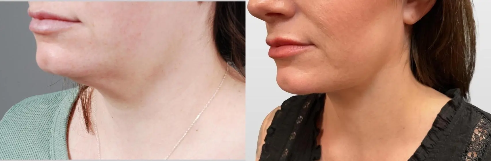 Facelift & Neck Lift: Patient 3 - Before and After 1