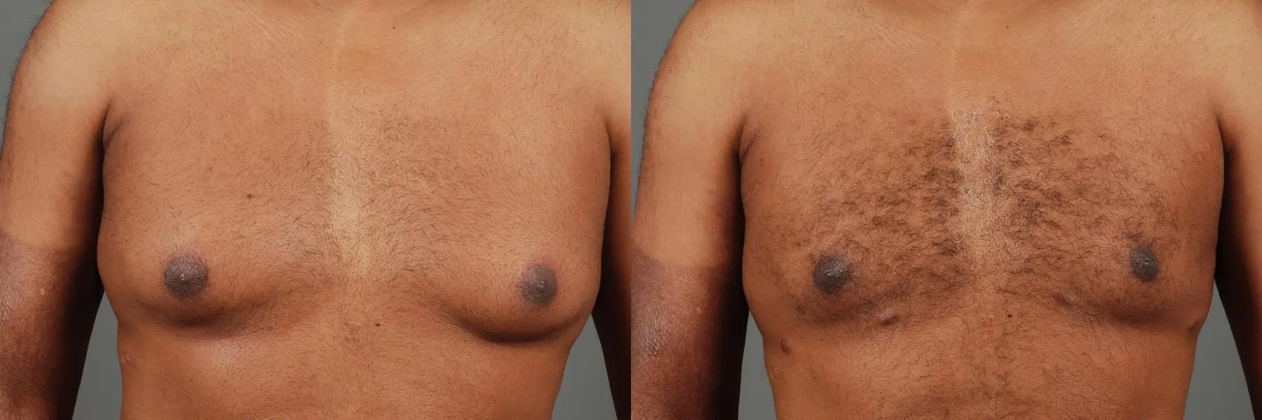 Gynecomastia: Patient 1 - Before and After  