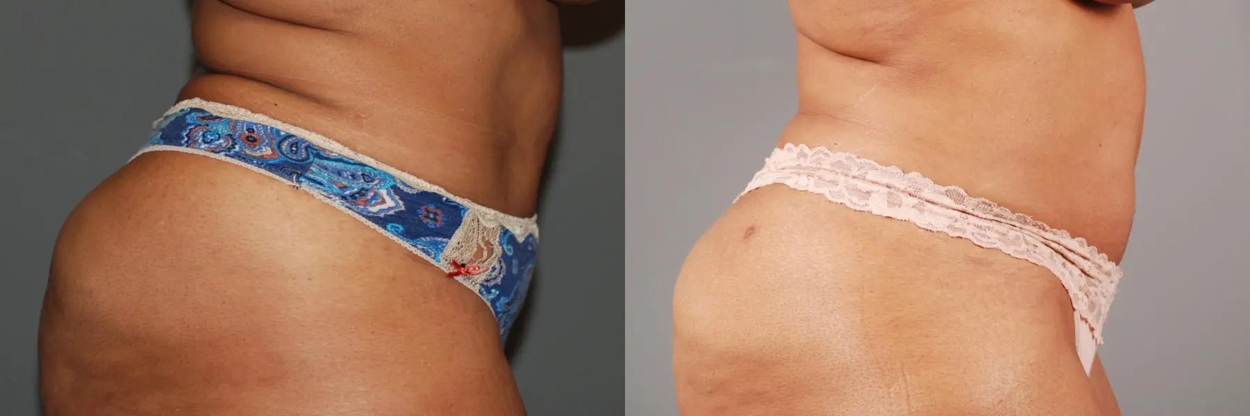 Liposuction: Patient 5 - Before and After 3