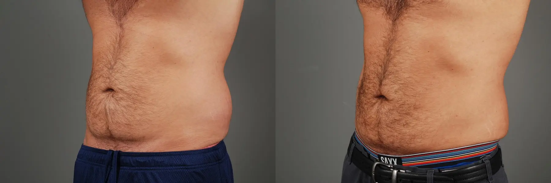Liposuction: Patient 3 - Before and After 4