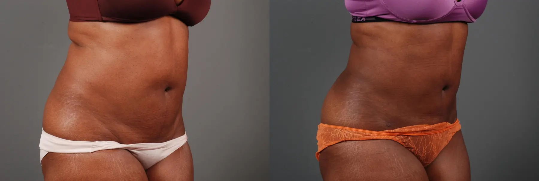 Liposuction: Patient 2 - Before and After 4