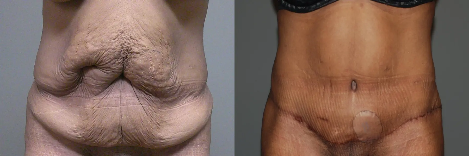 Liposuction: Patient 6 - Before and After 1