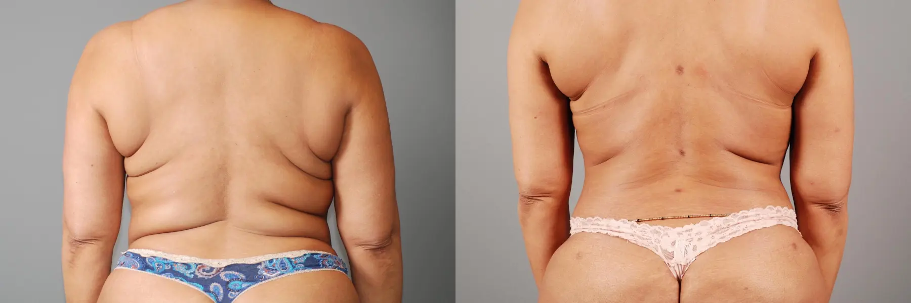 Liposuction: Patient 5 - Before and After 6