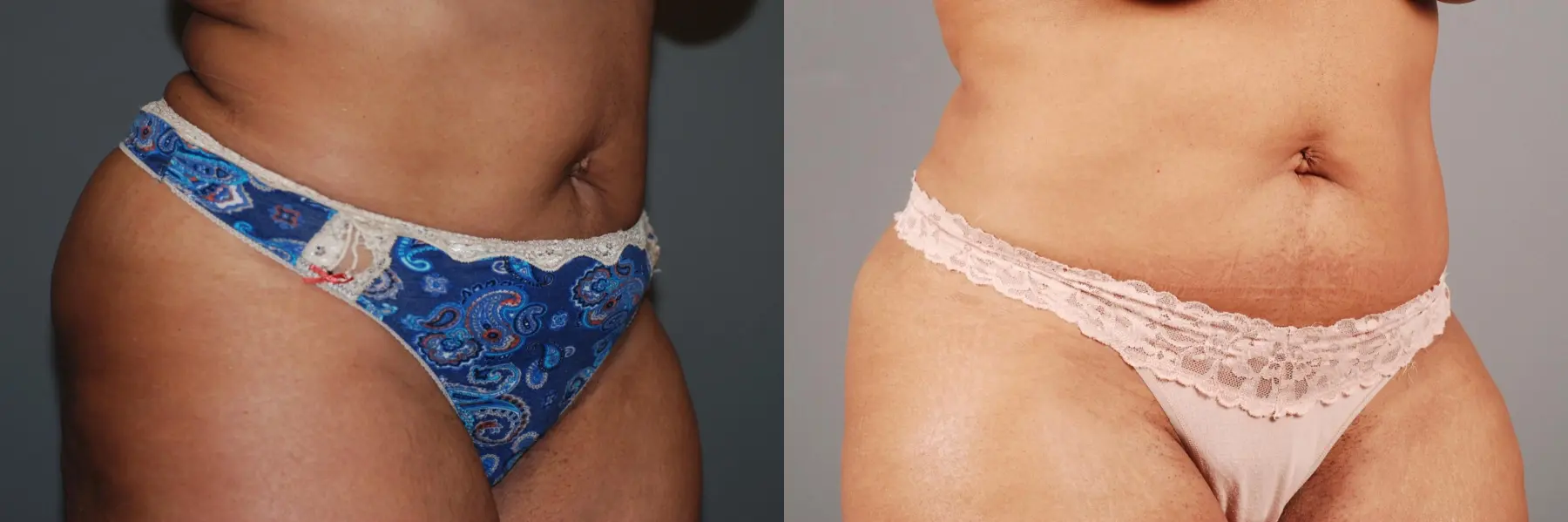 Liposuction: Patient 5 - Before and After 2