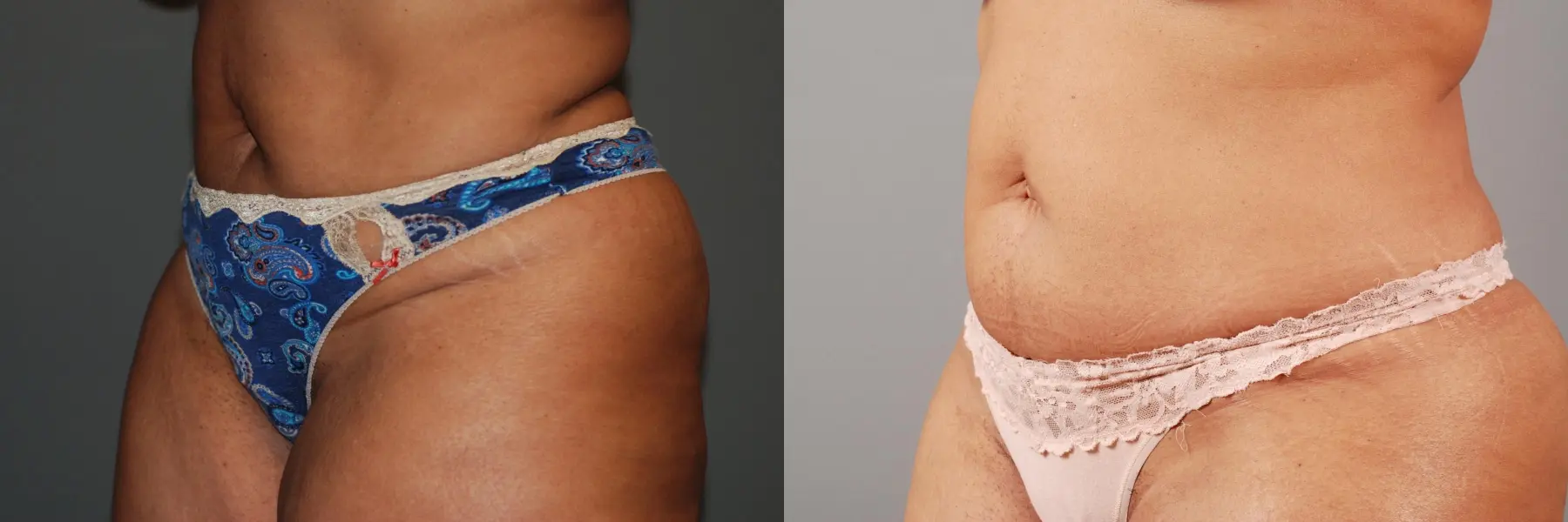 Liposuction: Patient 5 - Before and After 4