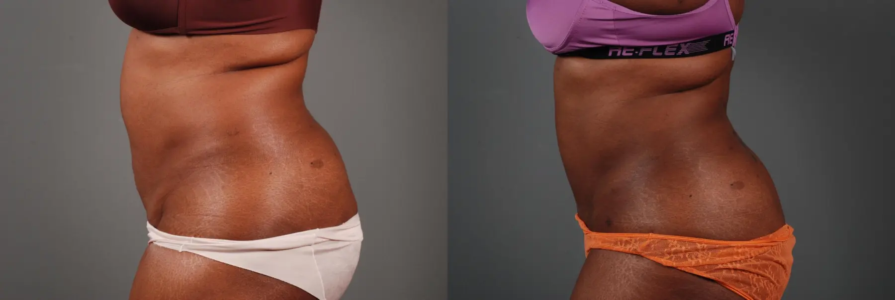 Liposuction: Patient 2 - Before and After 3
