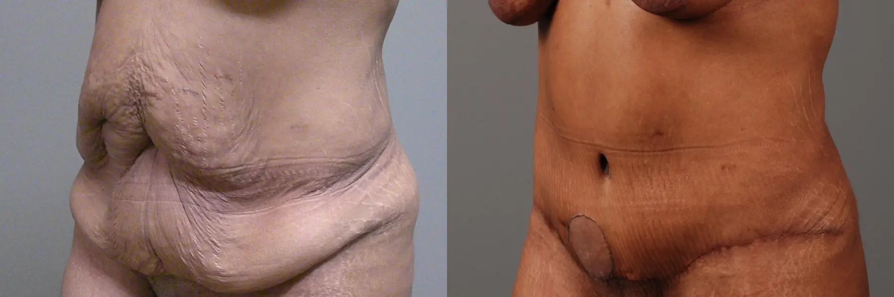 Liposuction: Patient 6 - Before and After 4