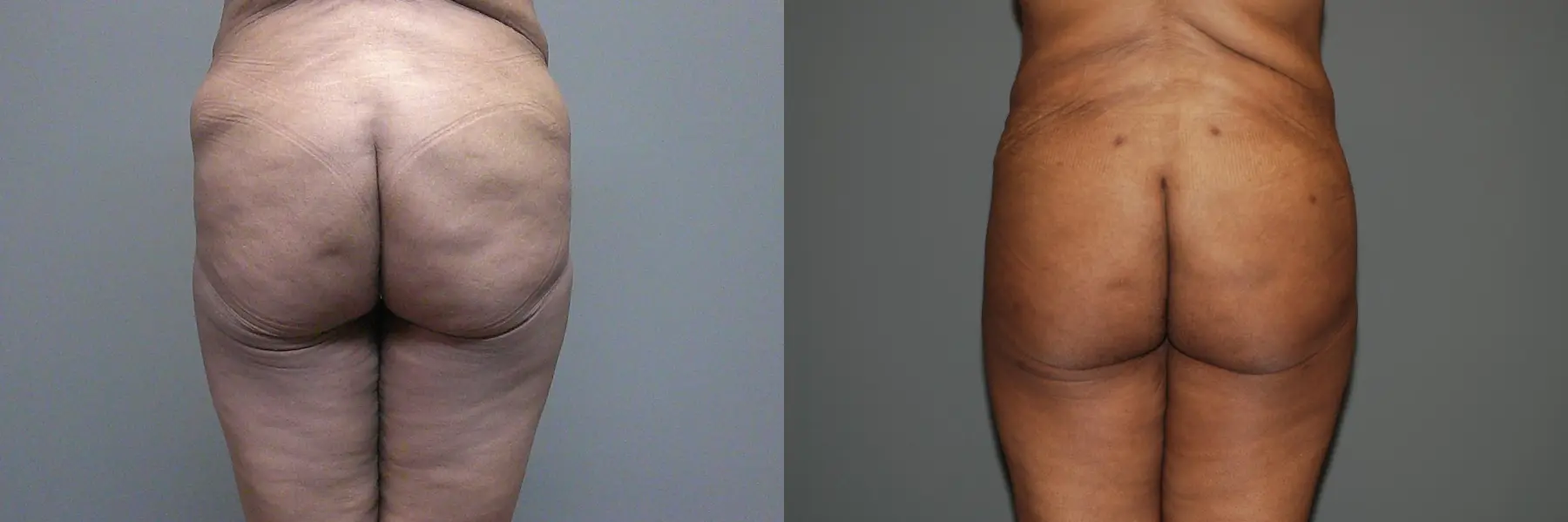 Liposuction: Patient 6 - Before and After 6