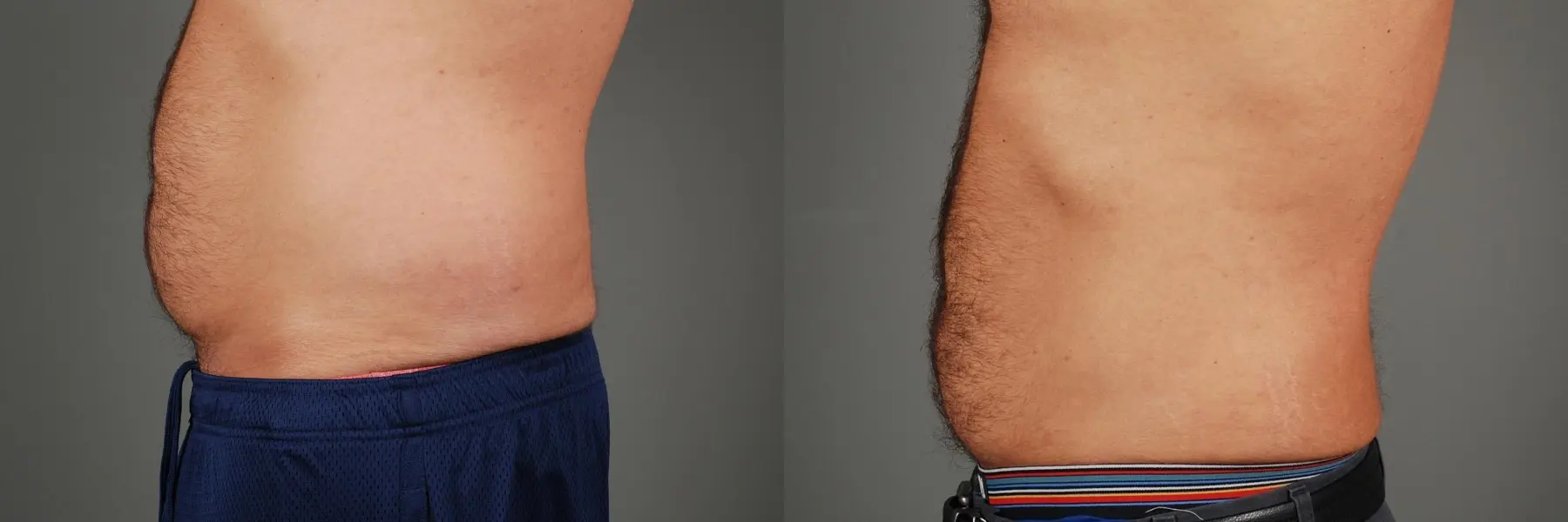 Liposuction: Patient 3 - Before and After 1