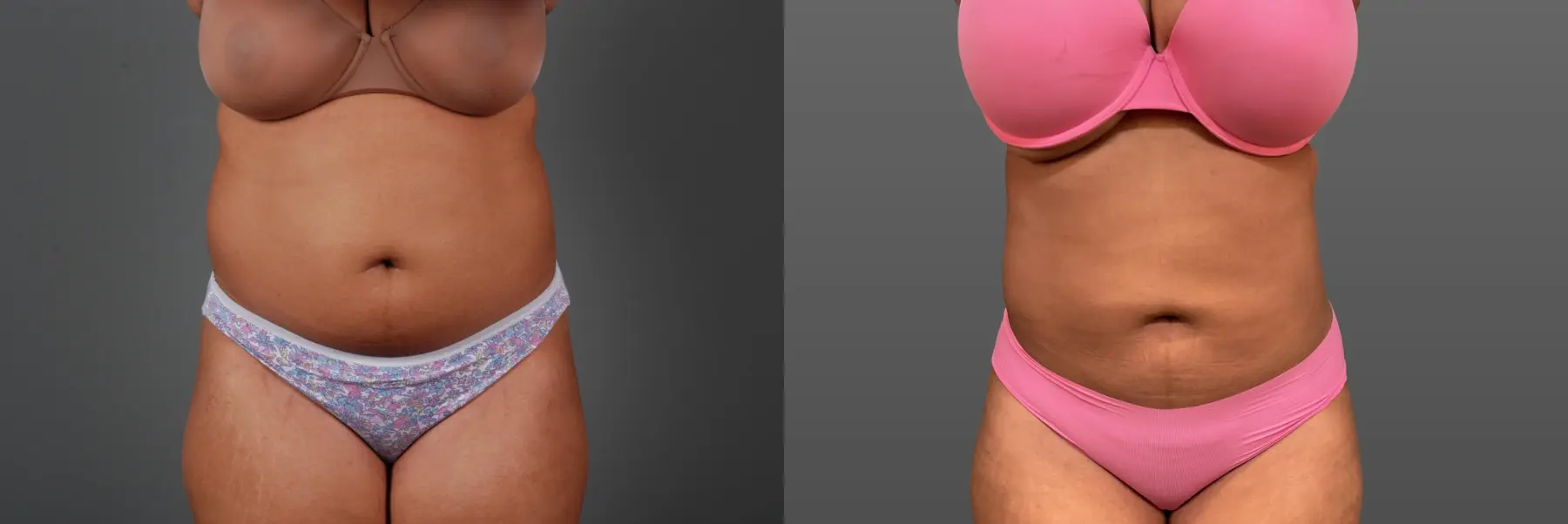 Liposuction: Patient 7 - Before and After 1