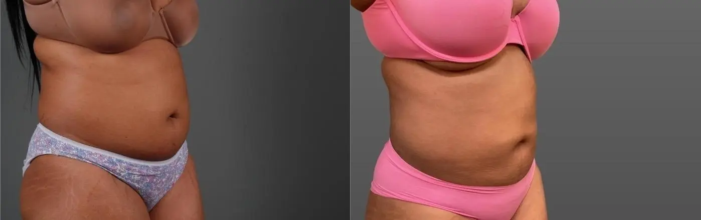 Liposuction: Patient 7 - Before and After 4