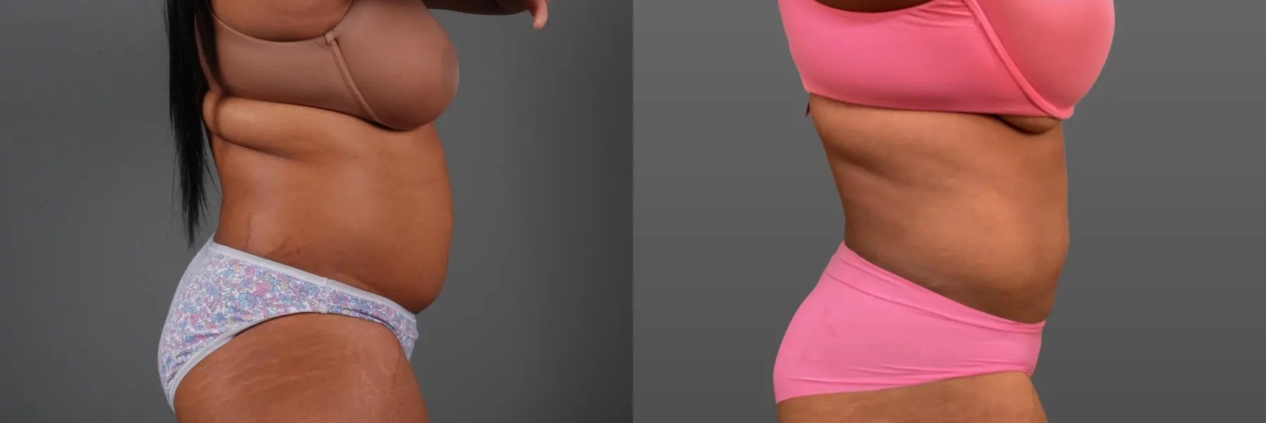 Liposuction: Patient 7 - Before and After 2