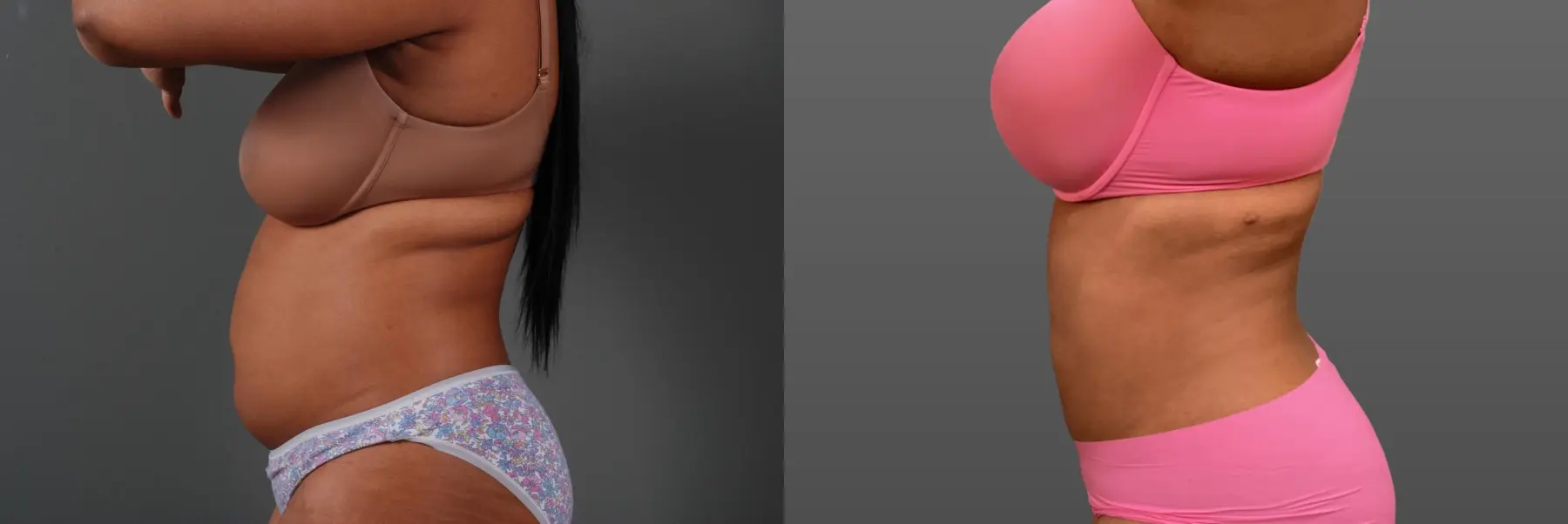 Liposuction: Patient 7 - Before and After 3