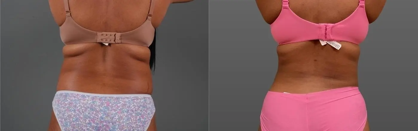 Liposuction: Patient 7 - Before and After 5