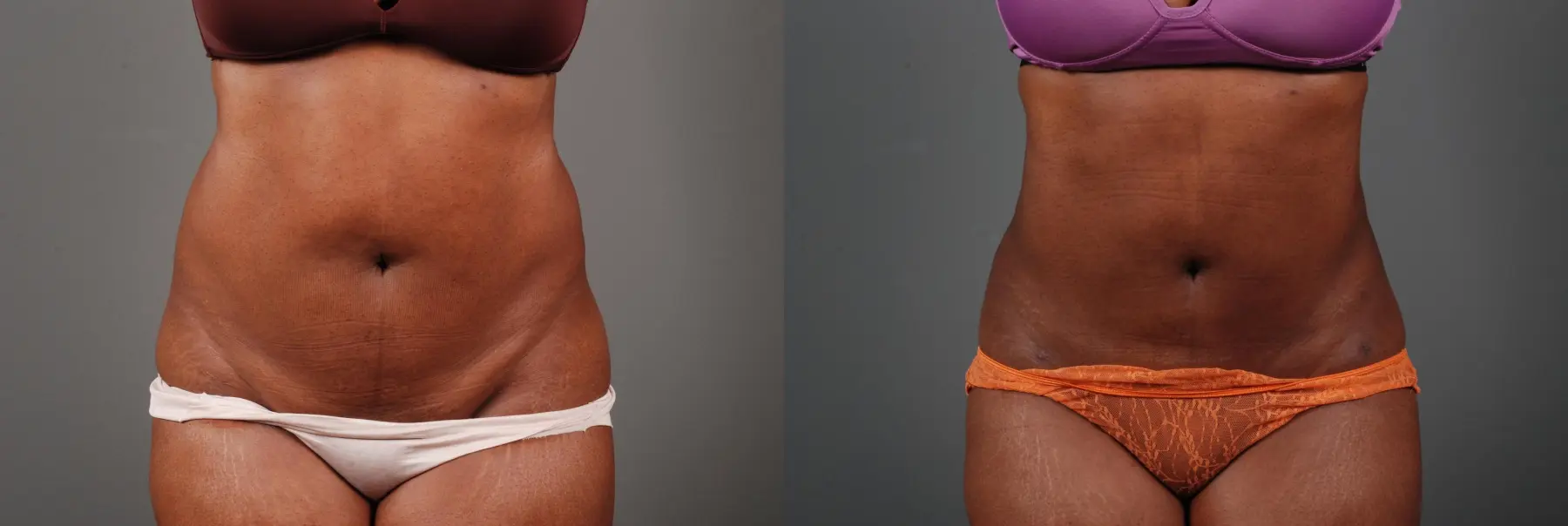 Liposuction: Patient 2 - Before and After 1