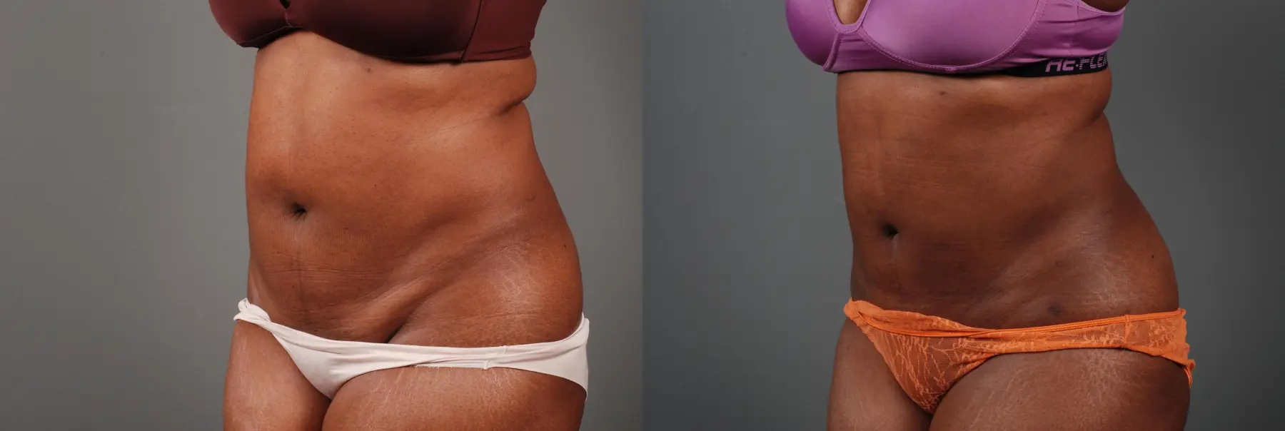Liposuction: Patient 2 - Before and After 2