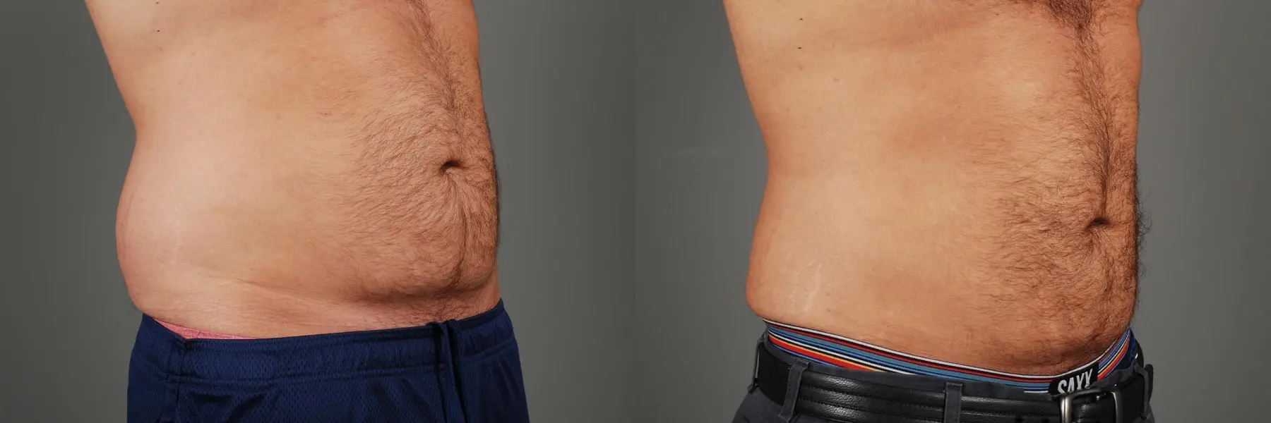 Liposuction: Patient 3 - Before and After 3