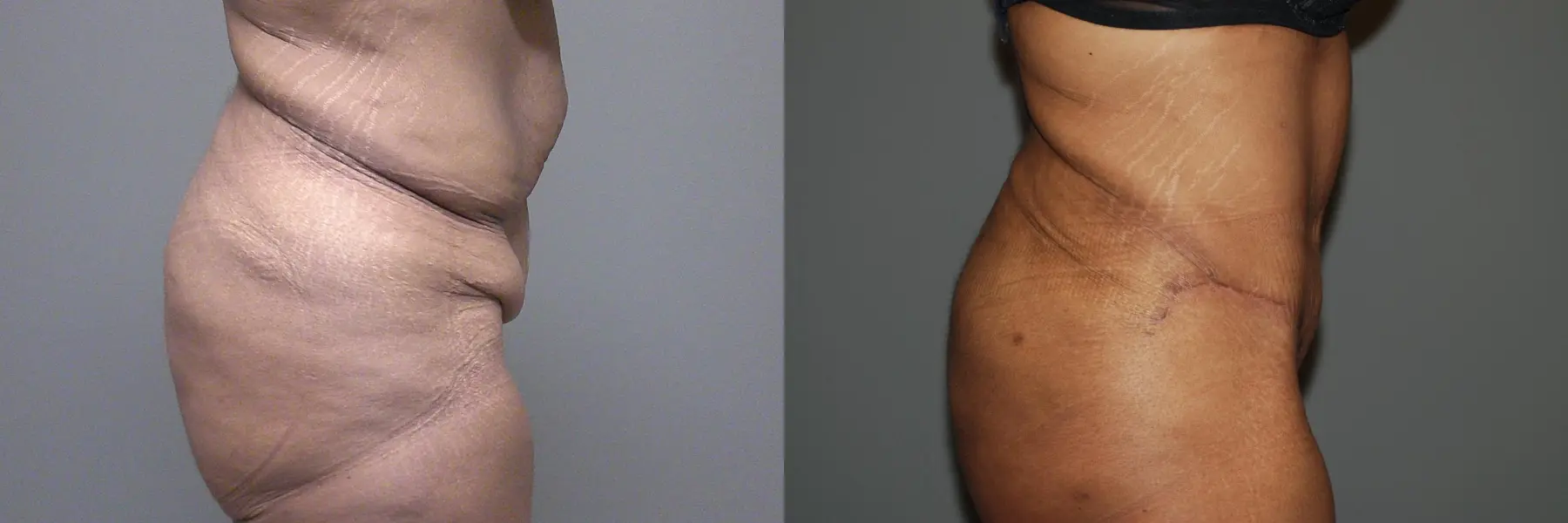 Liposuction: Patient 6 - Before and After 3
