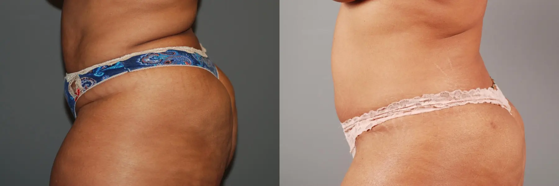 Liposuction: Patient 5 - Before and After 5