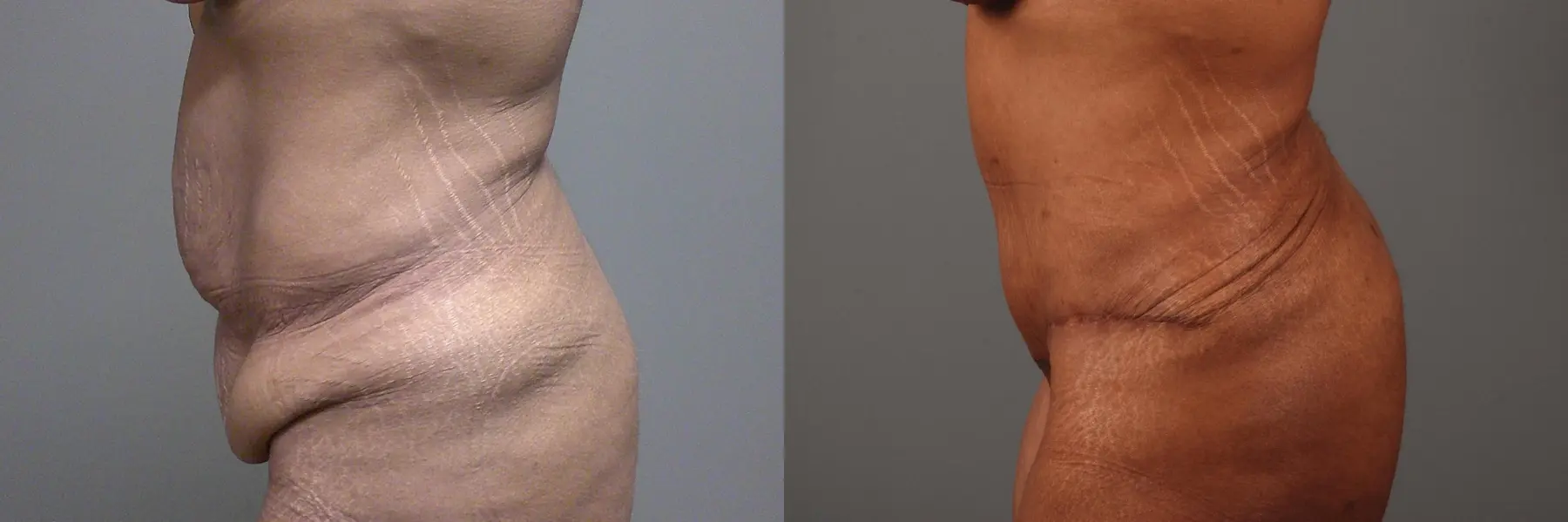 Liposuction: Patient 6 - Before and After 5