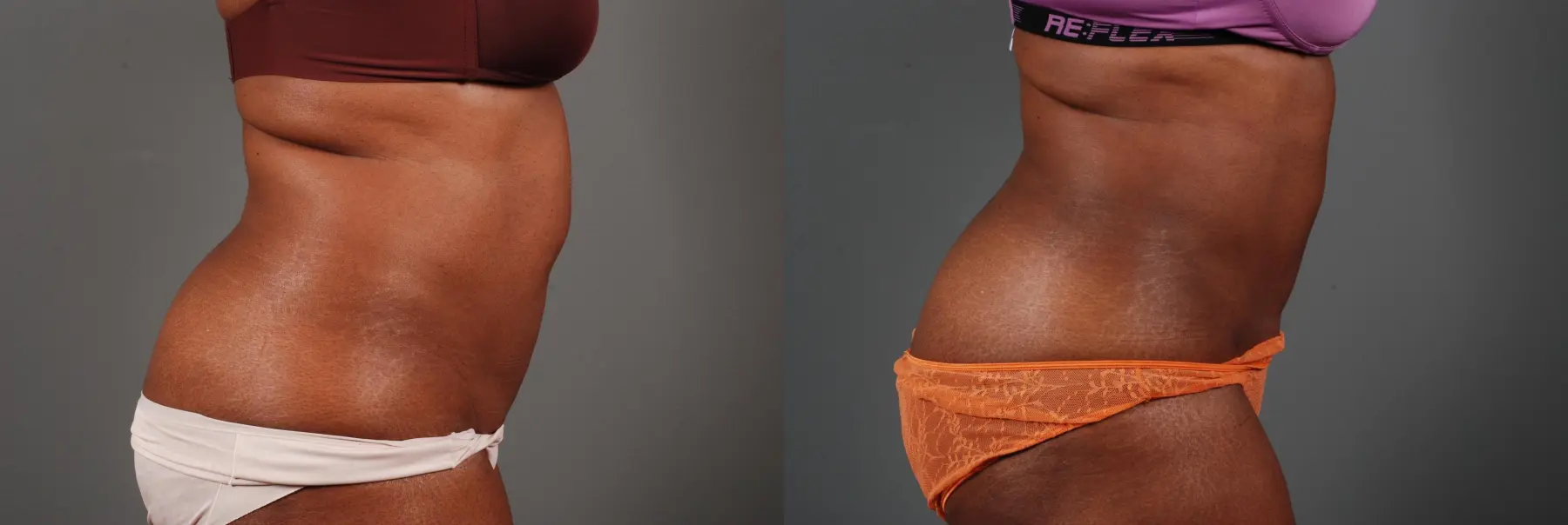 Liposuction: Patient 2 - Before and After 5