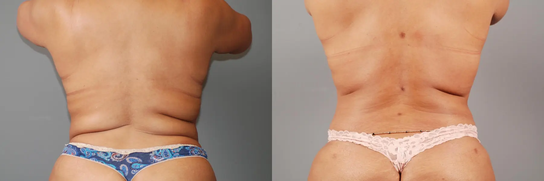 Liposuction: Patient 5 - Before and After 7