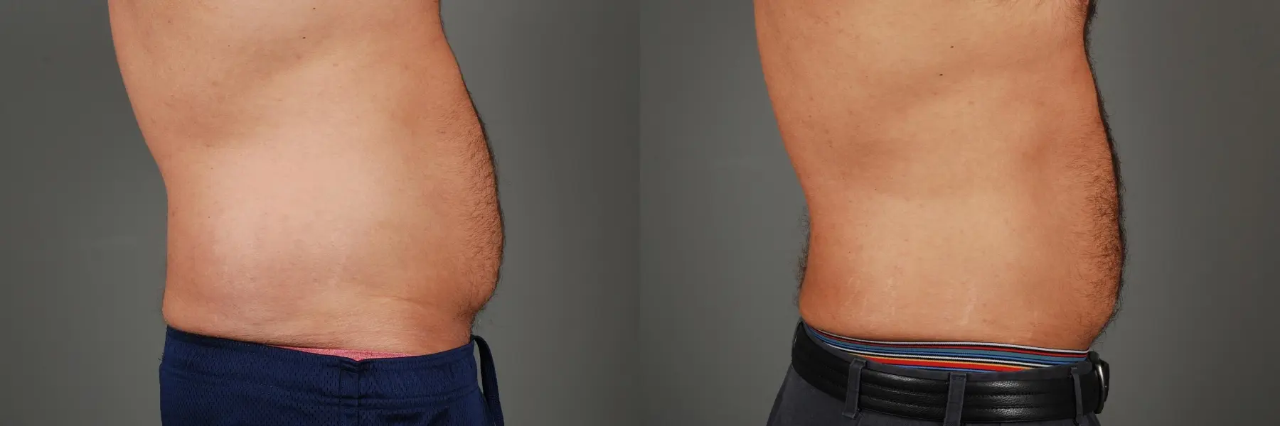 Liposuction: Patient 3 - Before and After 5