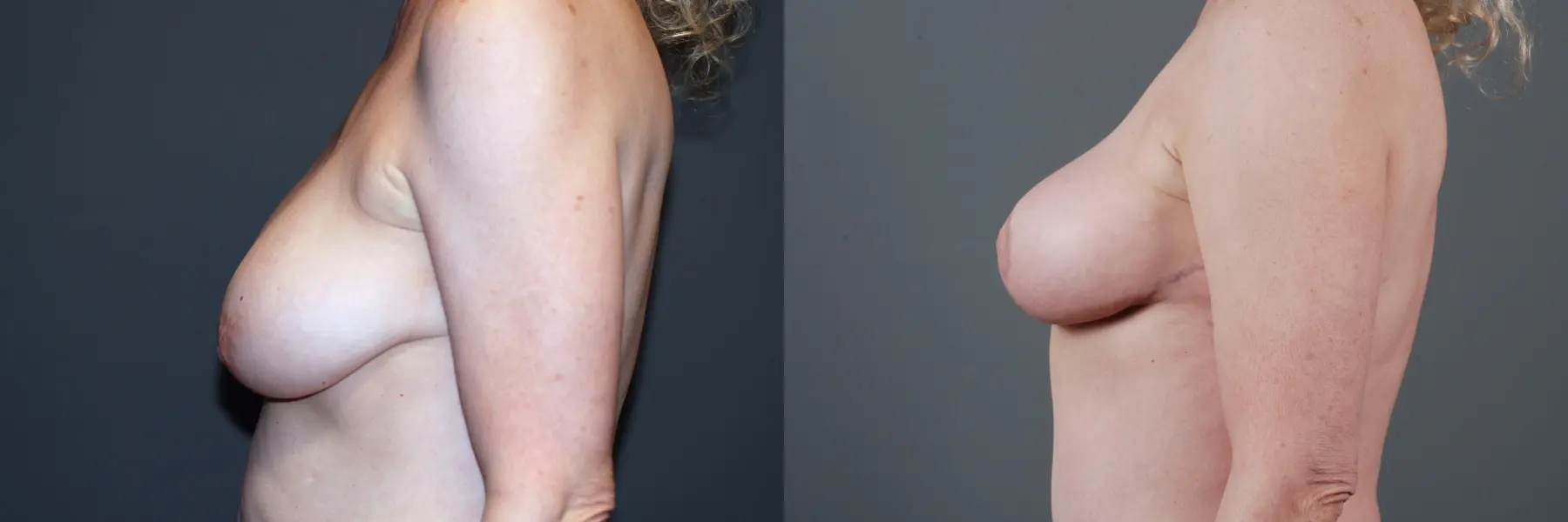 Mastopexy: Patient 1 - Before and After 2