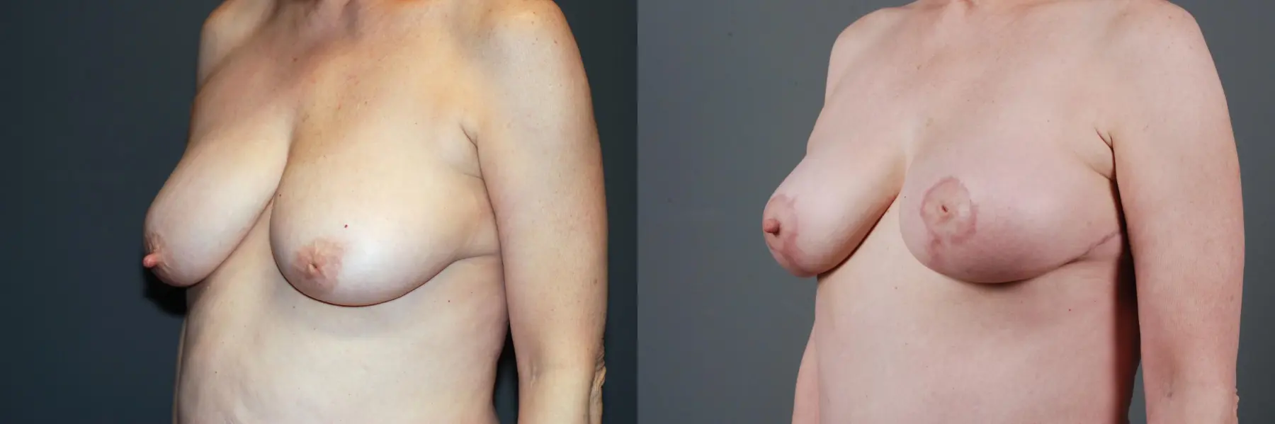 Mastopexy: Patient 1 - Before and After 5