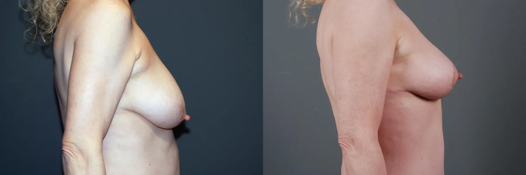 Mastopexy: Patient 1 - Before and After 1