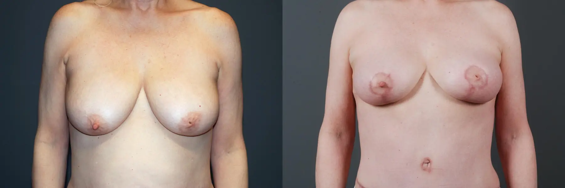 Mastopexy: Patient 1 - Before and After 3