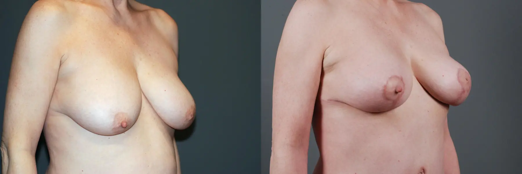 Mastopexy: Patient 1 - Before and After 4