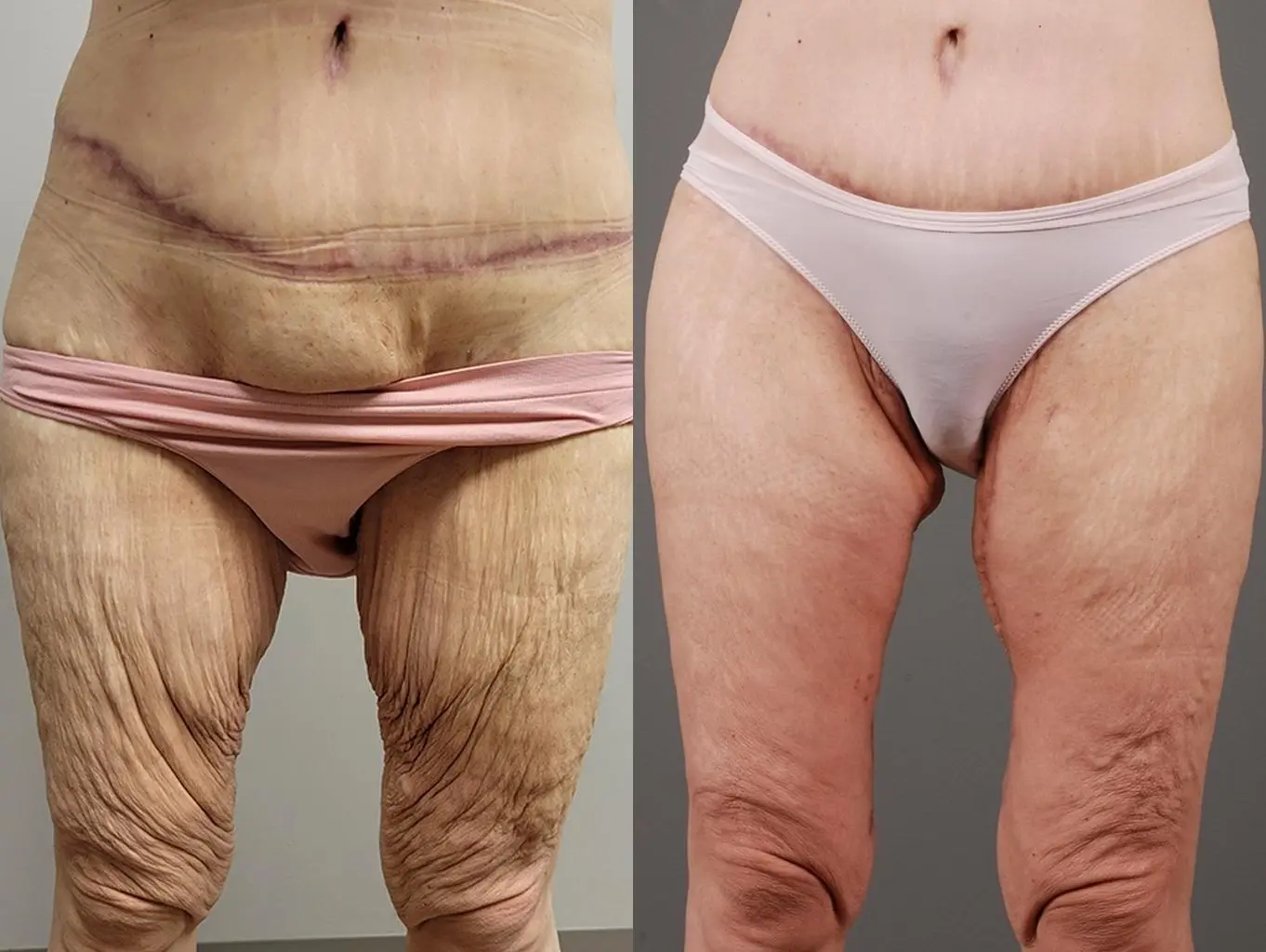 Thigh Lift: Patient 1 - Before and After 1