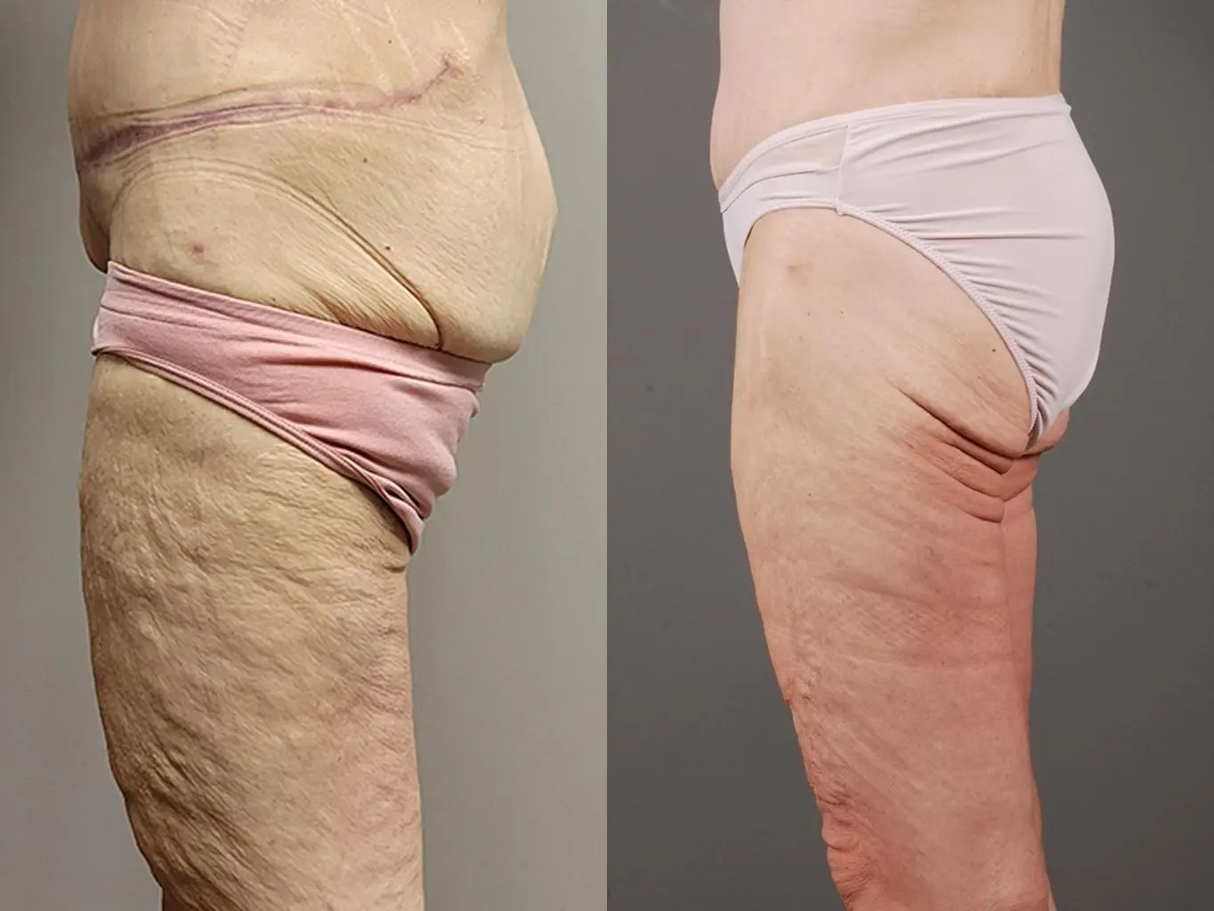 Thigh Lift: Patient 1 - Before and After 4